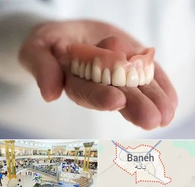 لیفت لثه با لیزر در بانه