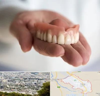 لیفت لثه با لیزر در یاسوج