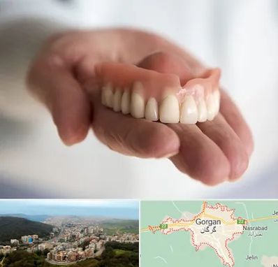 لیفت لثه با لیزر در گرگان