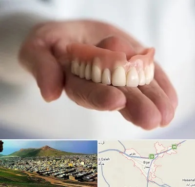 لیفت لثه با لیزر در بیجار