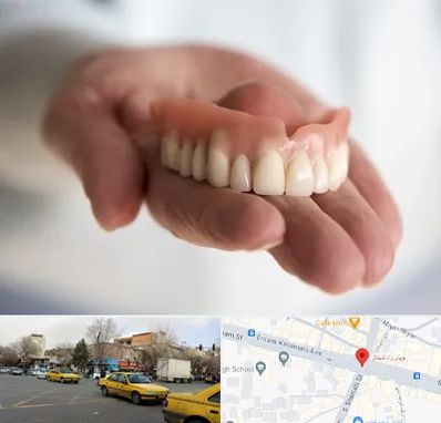 لیفت لثه با لیزر در شهناز تبریز