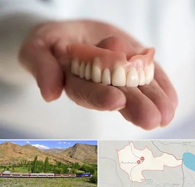 لیفت لثه با لیزر در خاش