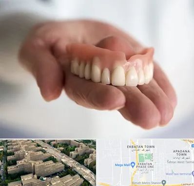 لیفت لثه با لیزر در اکباتان 