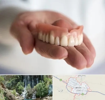 لیفت لثه با لیزر در شیروان