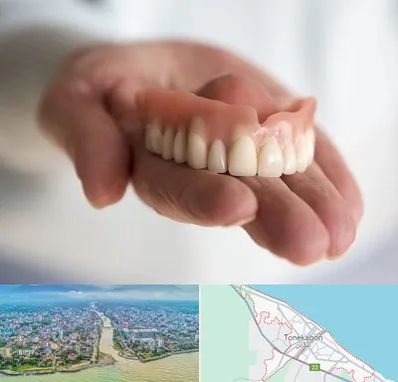 لیفت لثه با لیزر در تنکابن