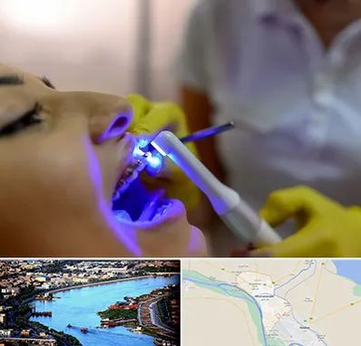 دندانپزشکی با لیزر در خرمشهر