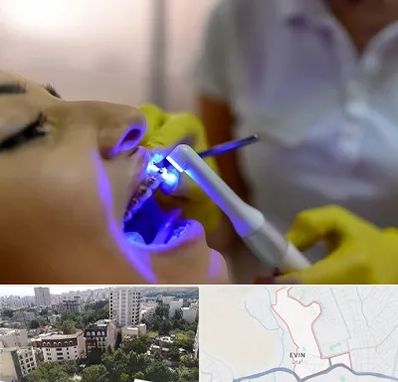 دندانپزشکی با لیزر در اوین