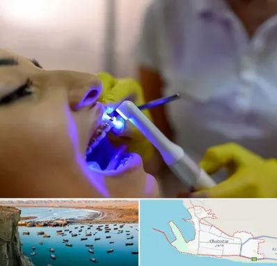 دندانپزشکی با لیزر در چابهار