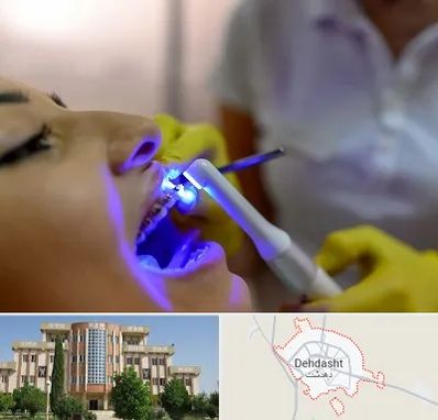 دندانپزشکی با لیزر در دهدشت