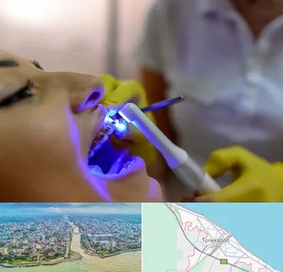 دندانپزشکی با لیزر در تنکابن