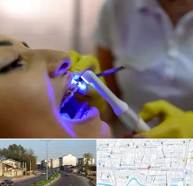 دندانپزشکی با لیزر در ضیابری رشت