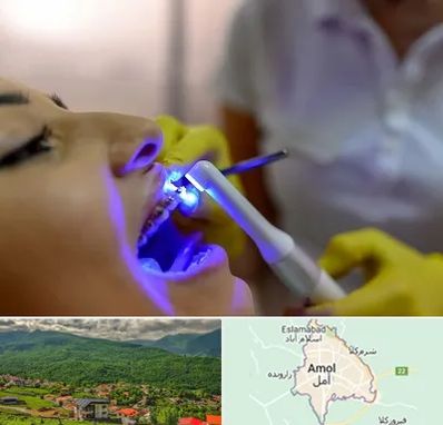 دندانپزشکی با لیزر در آمل