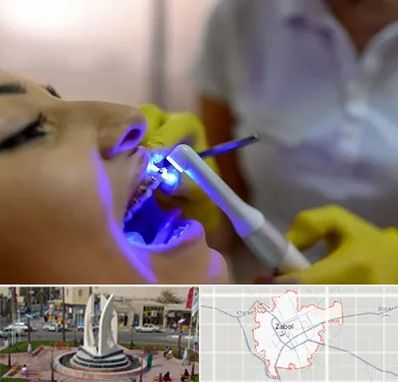 دندانپزشکی با لیزر در زابل