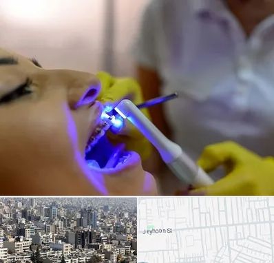 دندانپزشکی با لیزر در جیحون