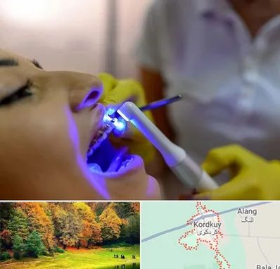 دندانپزشکی با لیزر در کردکوی