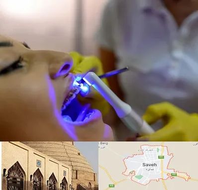 دندانپزشکی با لیزر در ساوه