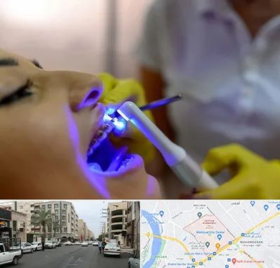 دندانپزشکی با لیزر در زیتون کارمندی اهواز