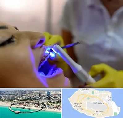 دندانپزشکی با لیزر در کیش