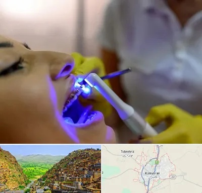 دندانپزشکی با لیزر در کامیاران