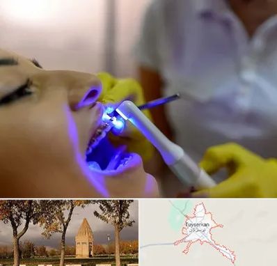 دندانپزشکی با لیزر در تویسرکان