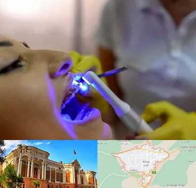 دندانپزشکی با لیزر در خوی