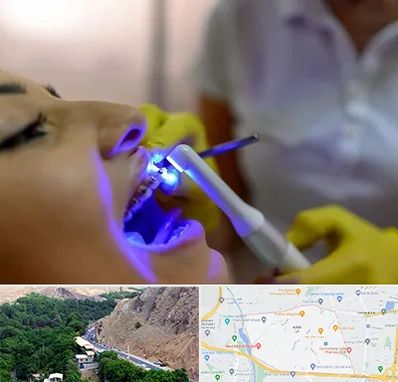 دندانپزشکی با لیزر در کن