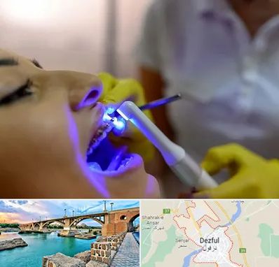دندانپزشکی با لیزر در دزفول
