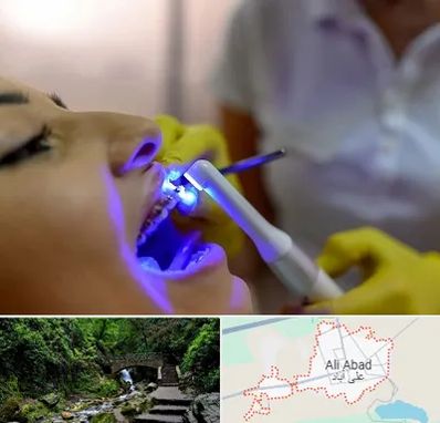 دندانپزشکی با لیزر در علی آباد کتول