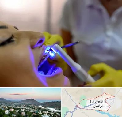 دندانپزشکی با لیزر در لواسان