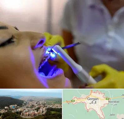 دندانپزشکی با لیزر در گرگان