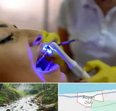 دندانپزشکی با لیزر در رویان