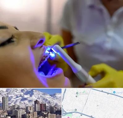 دندانپزشکی با لیزر در ازگل