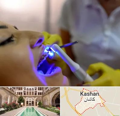 دندانپزشکی با لیزر در کاشان