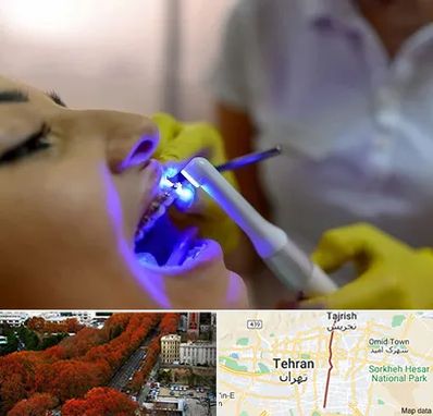 دندانپزشکی با لیزر در ولیعصر 