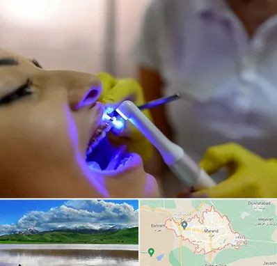 دندانپزشکی با لیزر در مرند