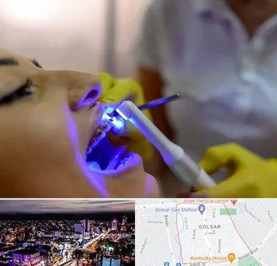 دندانپزشکی با لیزر در گلسار رشت 