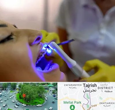 دندانپزشکی با لیزر در تجریش 