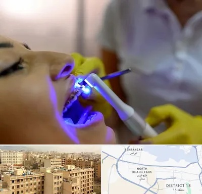دندانپزشکی با لیزر در جنوب غرب تهران