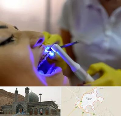 دندانپزشکی با لیزر در شهرضا