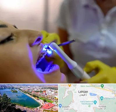 دندانپزشکی با لیزر در لاهیجان