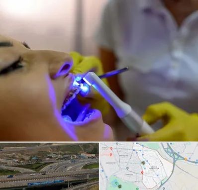 دندانپزشکی با لیزر در یاغچیان تبریز