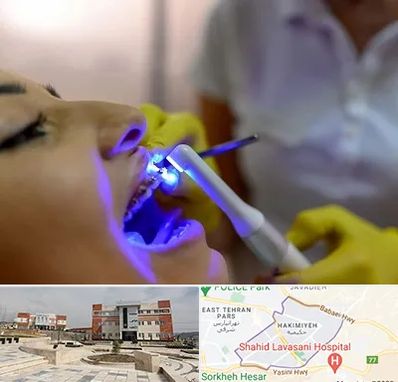 دندانپزشکی با لیزر در حکیمیه 