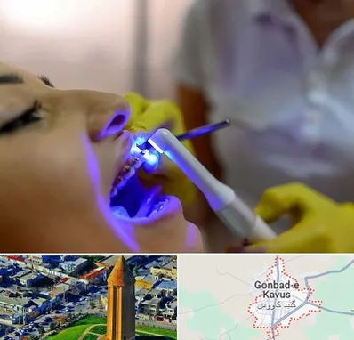 دندانپزشکی با لیزر در گنبد کاووس