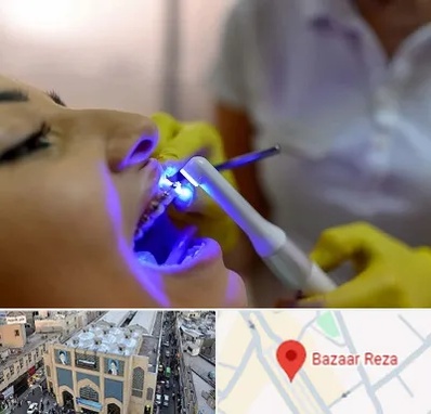 دندانپزشکی با لیزر در بازار رضا مشهد