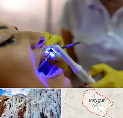 دندانپزشکی با لیزر در میگون