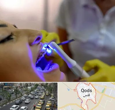 دندانپزشکی با لیزر در شهر قدس