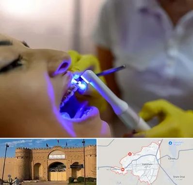 دندانپزشکی با لیزر در ایرانشهر