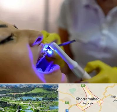 دندانپزشکی با لیزر در خرم آباد