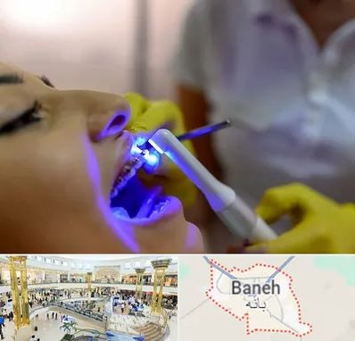 دندانپزشکی با لیزر در بانه