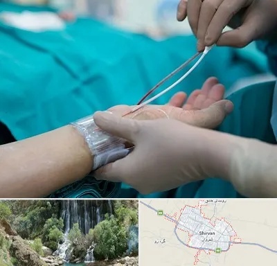 آنژیوگرافی در شیروان